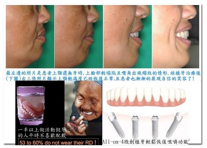 All-on-4 治療與活動假牙生活品質對比