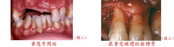 重度牙周病與齒槽骨破壞