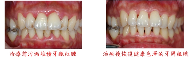 牙周病治療前後牙齦恢復比較