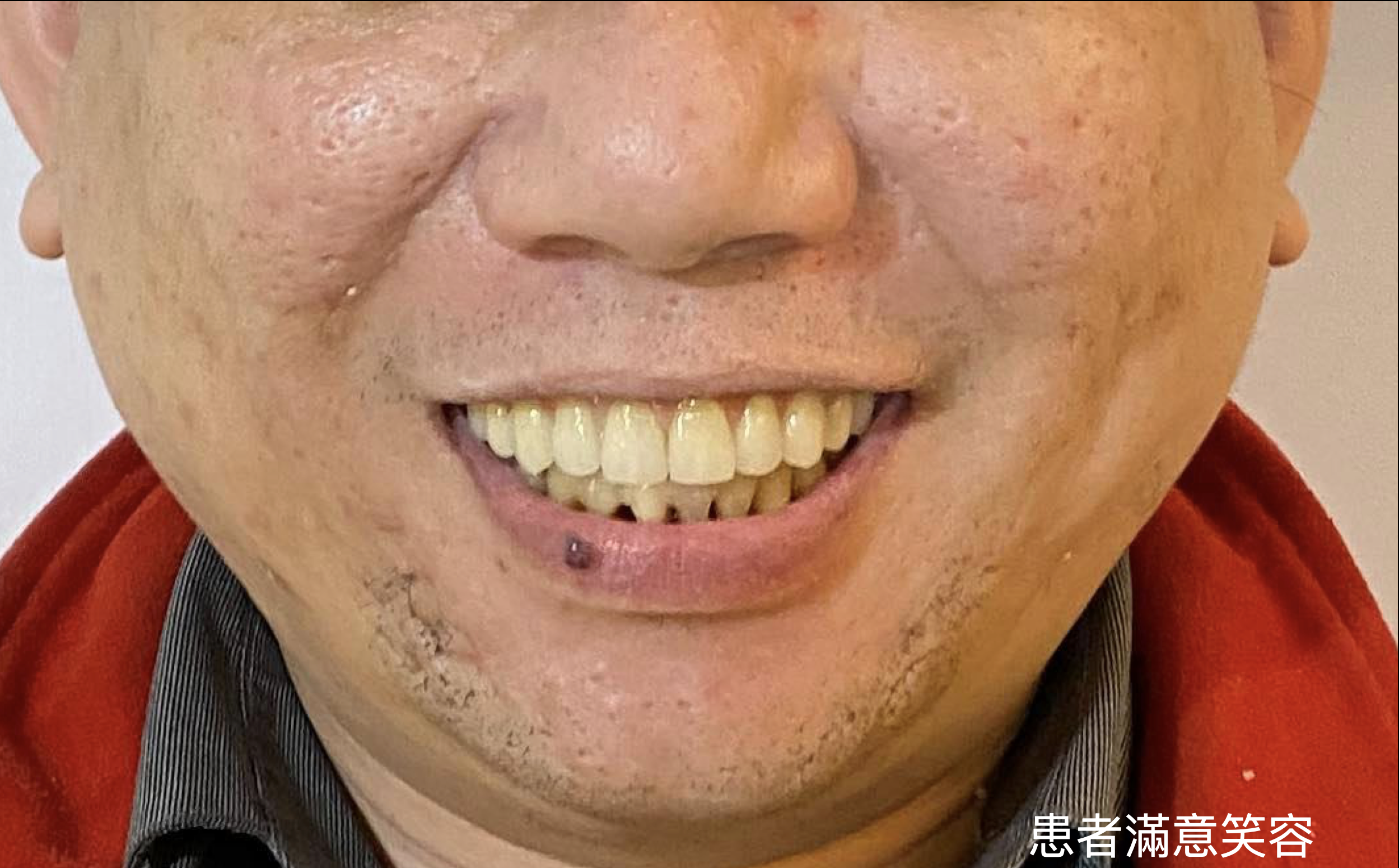 All-on-4 完成後整體案例紀錄