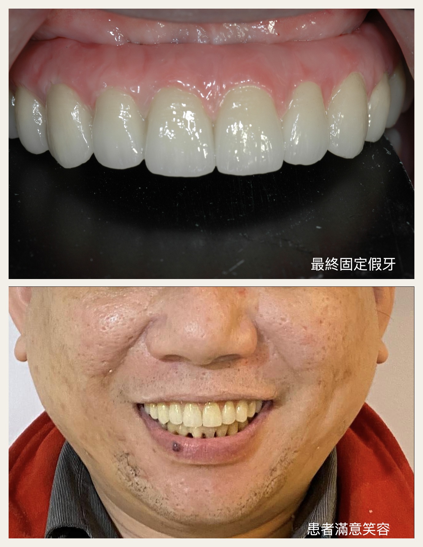 諾保科 TiUltra All-on-4 案例圖示